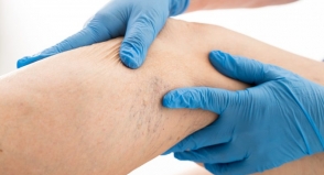 Cassind credencia novos angiologistas com melhor custo benefício