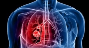 Campanha de vacinação contra Pneumonia está de volta